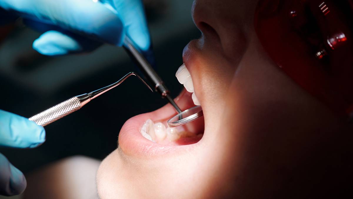 Стоматологи рассказали, кому нельзя делать профессиональную чистку зубов 