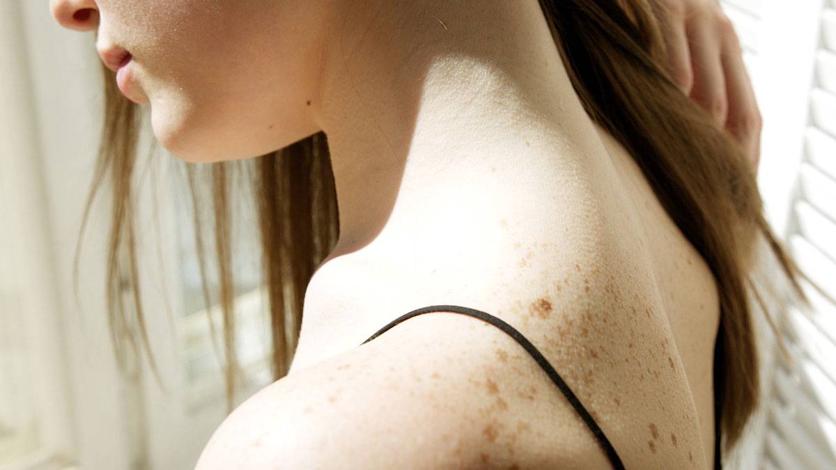 Дерматолог Сингх объяснил, почему рак кожи особенно опасен зимой