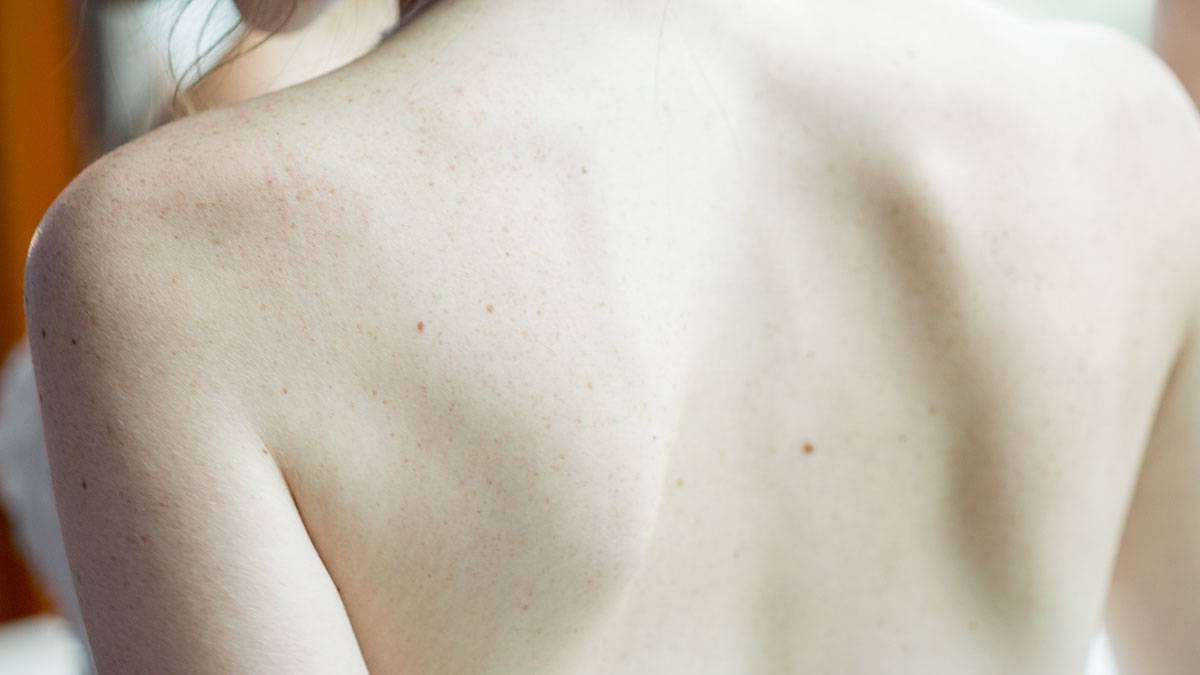 Дерматолог раскрыла причины ухудшения состояния кожи на спине