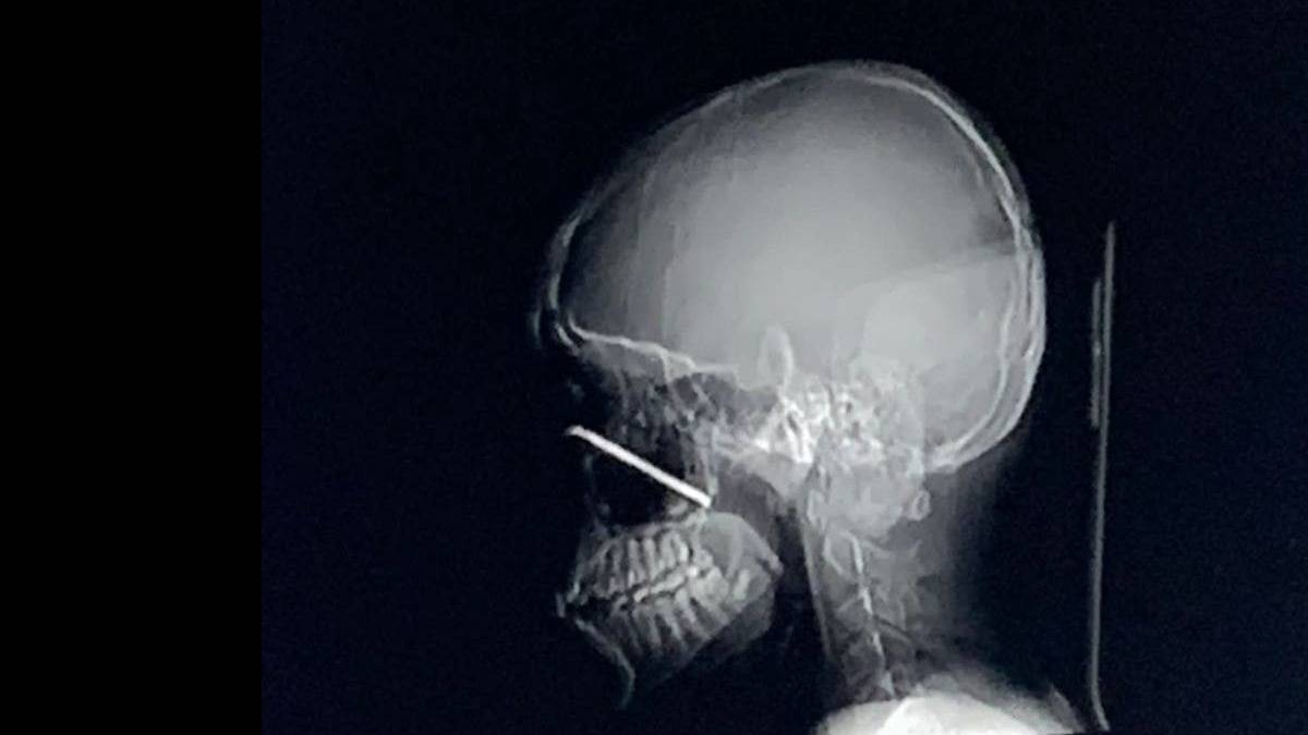 Подмосковные врачи вытащили металлический прут из глаза подростка