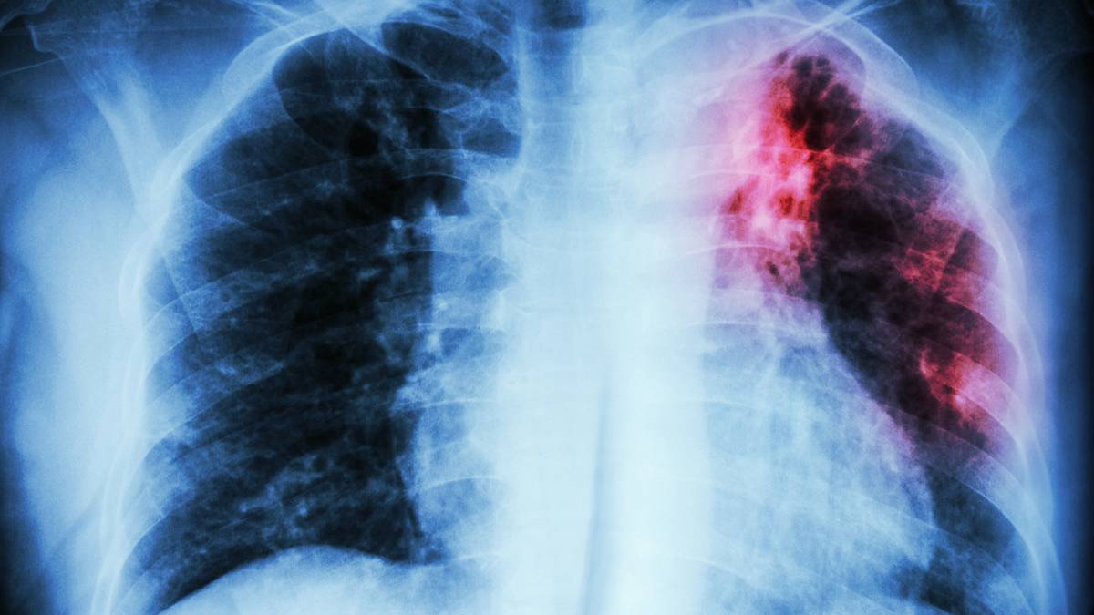 Врач Вознесенский рассказал о возможных последствиях нового штамма туберкулеза