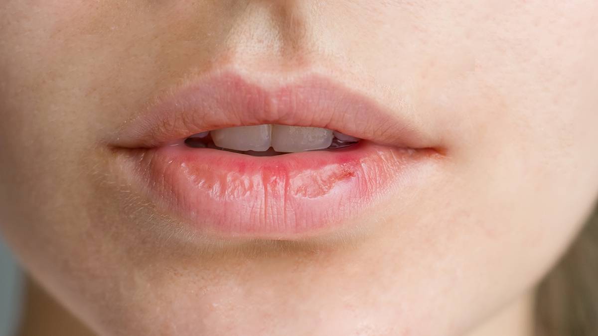 Пластический хирург Байрамукова рассказала, что делать, если все время сохнут губы
