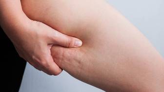 Можно ли с помощью массажа убрать целлюлит