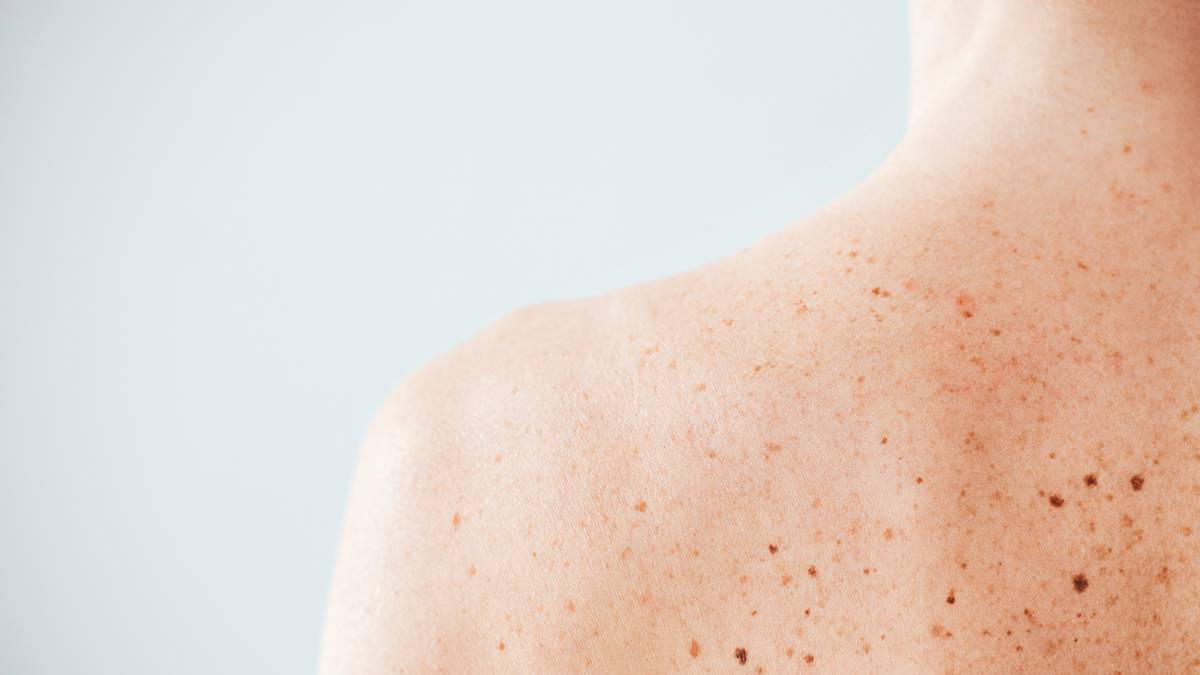Рак кожи: симптомы, неочевидные признаки и методы лечения