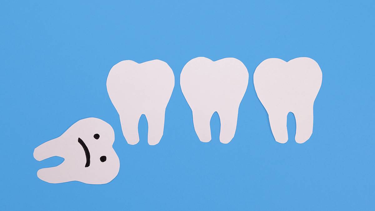 Зубы мудрости: когда их пора удалять и как облегчить восстановление