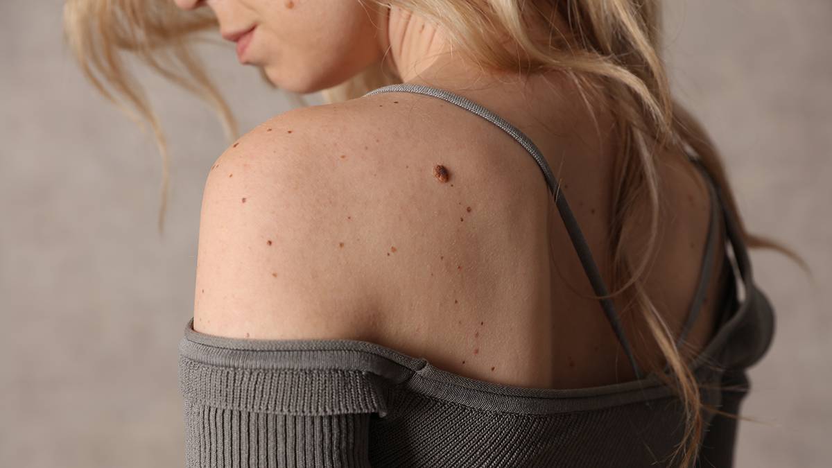 Дерматолог заявил, что нечеткие границы родинок могут говорить о раке кожи