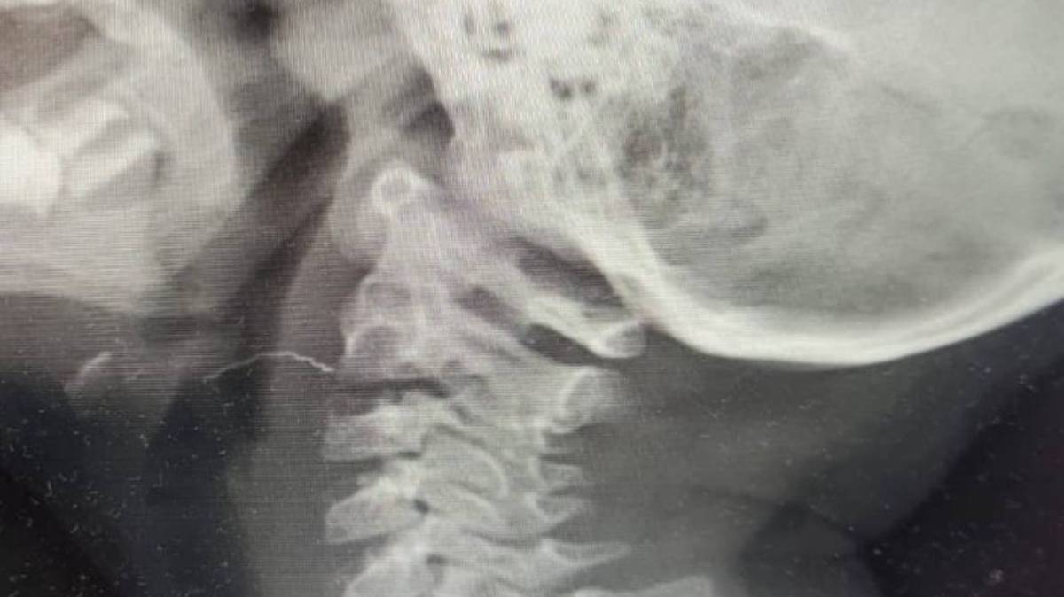 Двухлетняя девочка неделю проходила с проволокой в горле в Подмосковье