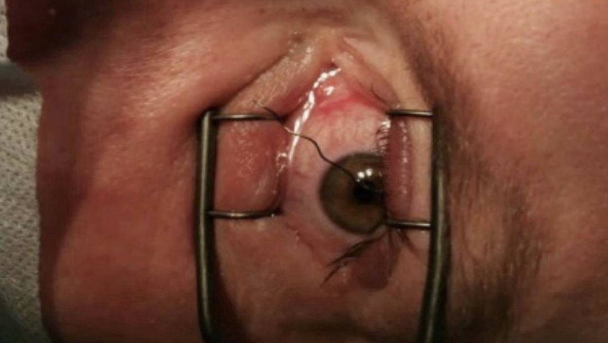 Подмосковные врачи спасли зрение мужчине с проволокой в глазу