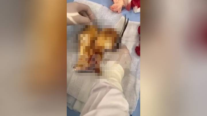 Врачи удалили огромный комок из желудка москвички, которая постоянно ела хлебцы