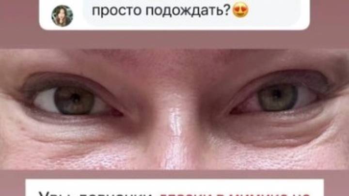 «Уродливые колбасы»: певица Дакота показала последствия неудачной пластики век