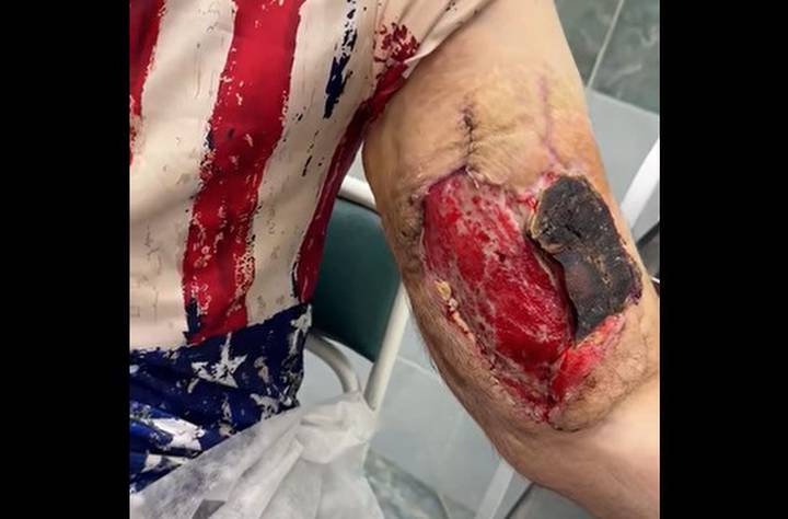 Гниение тканей: Кирилл «Руки-базуки» показал страшные последствия инъекций синтола