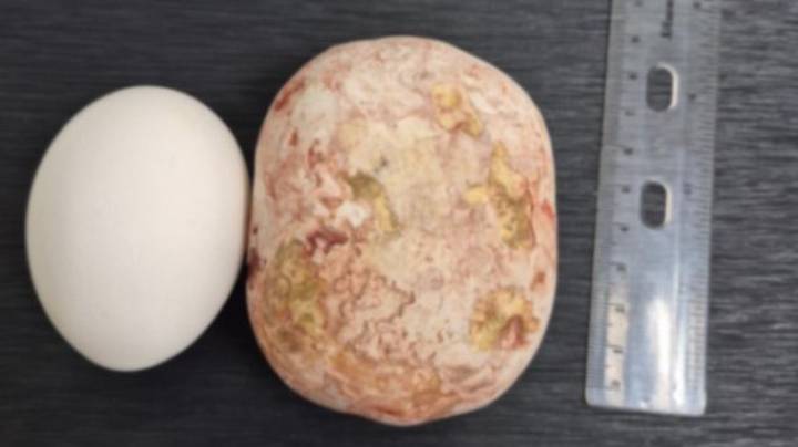 Врачи в Балаково извлекли килограммовый камень из мочевого пузыря пациента