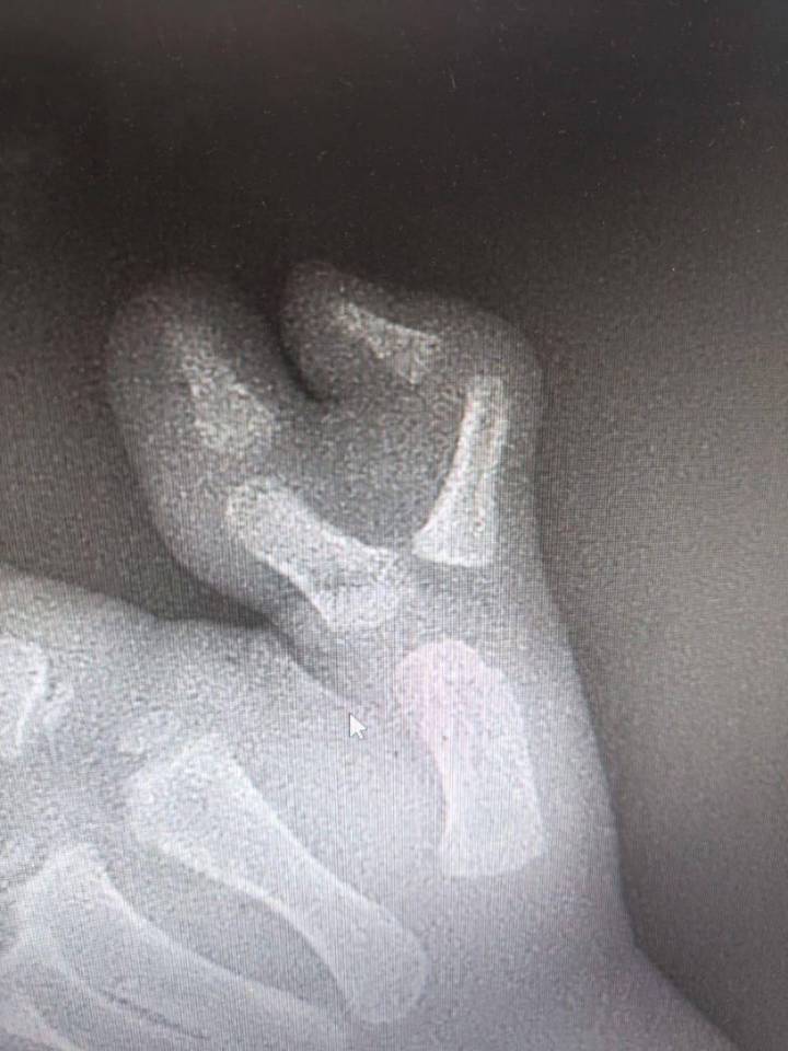 Подмосковные врачи удалили ребенку шестой палец на руке