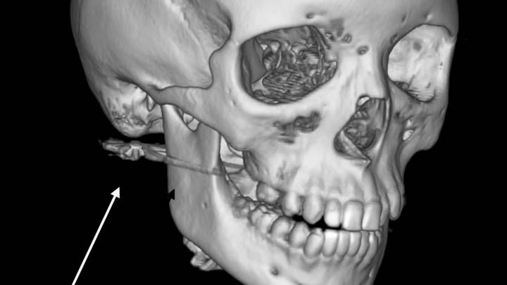 Мальчик в Приморье выстрелил из пневматики в лицо другу во время игры