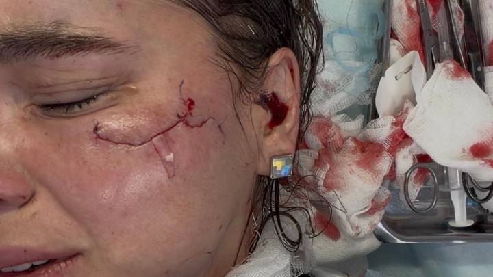 «Королеве красоты» изуродовали лицо на концерте «Тату» в Казани: полиция, личности нападавших и пострадавшей