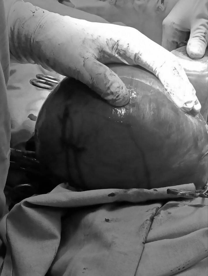 Подмосковной пациентке удалили миому весом более шести килограммов